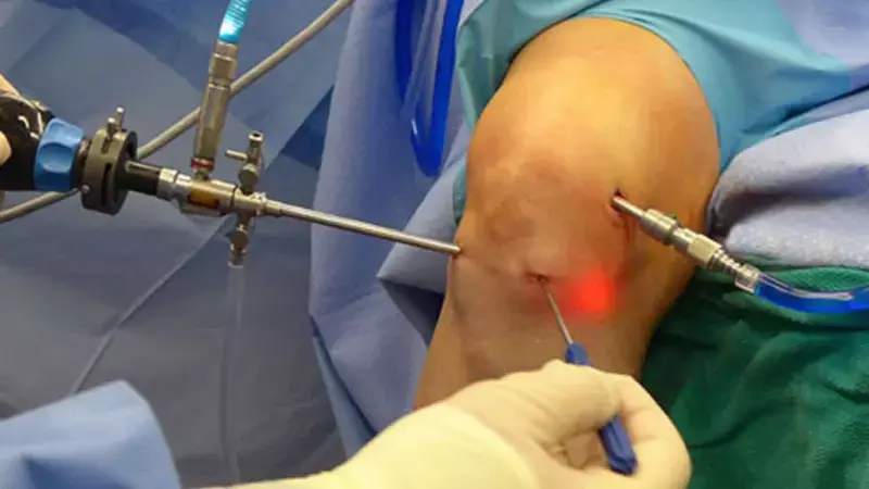 Arthroscopic Screw Fixation Package