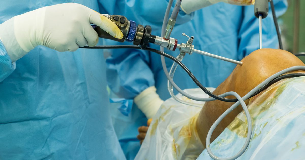 Arthroscopic Suture Anchor / Pull-Through Fixation Package