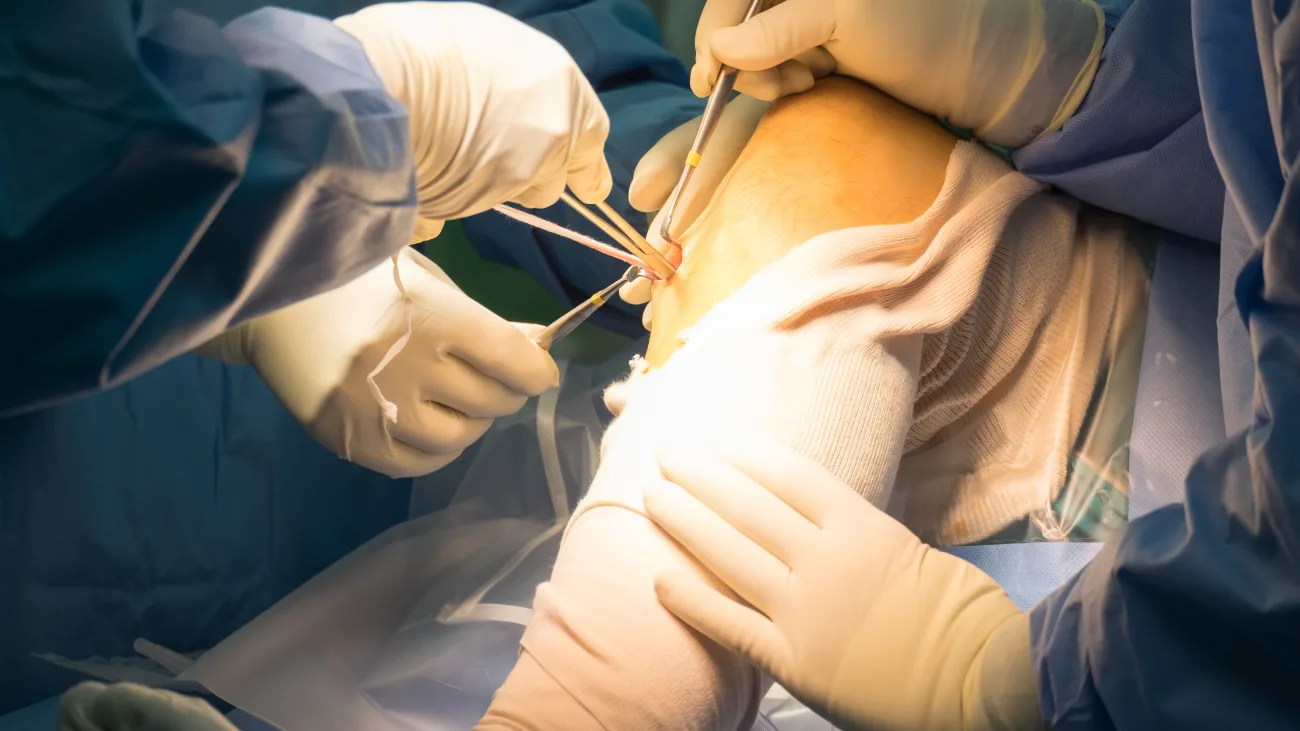 ACL Reconstruction (Single ACL) Package