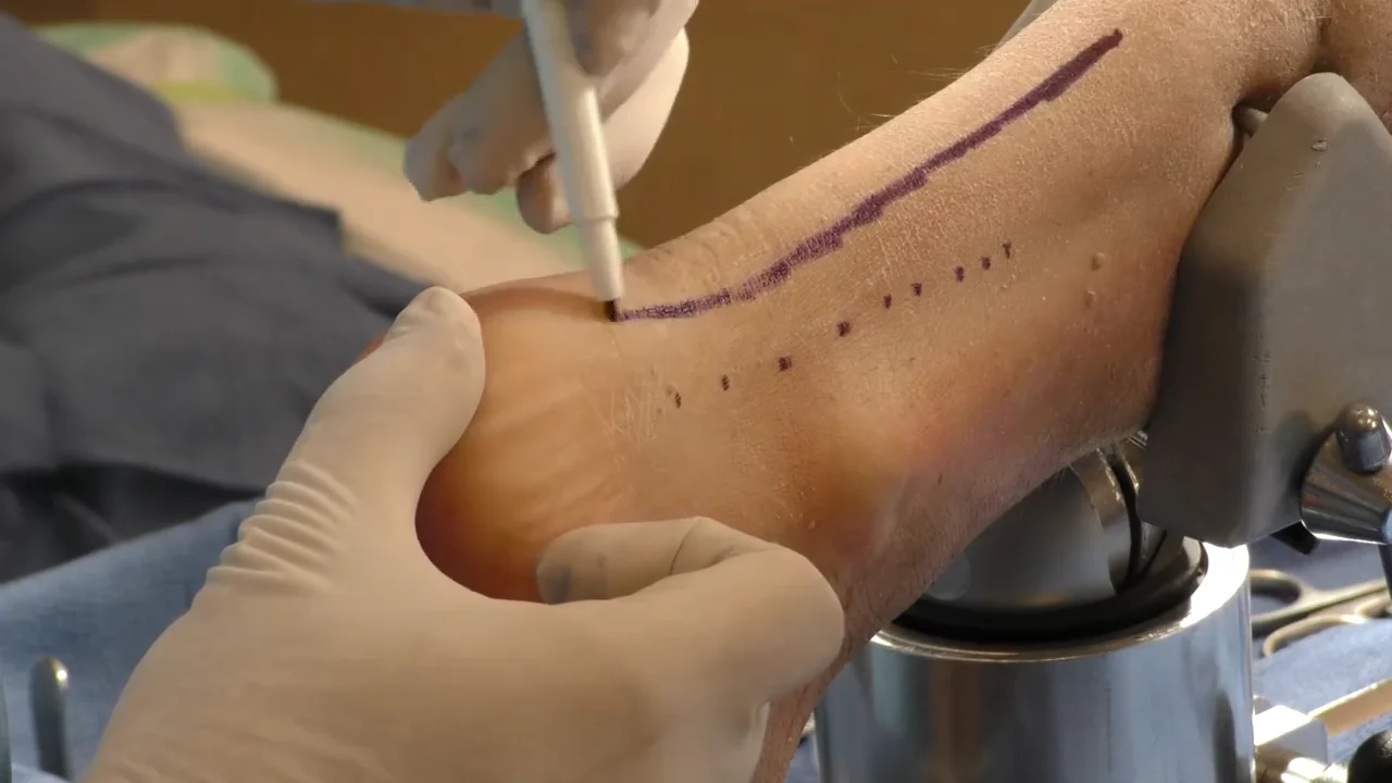 Tension Band Wiring Package (TBW / Percutaneous Screws)