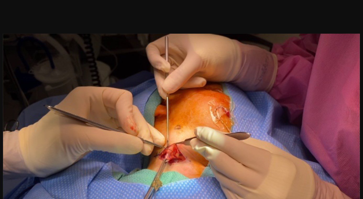 Branchial Cyst Excision Package