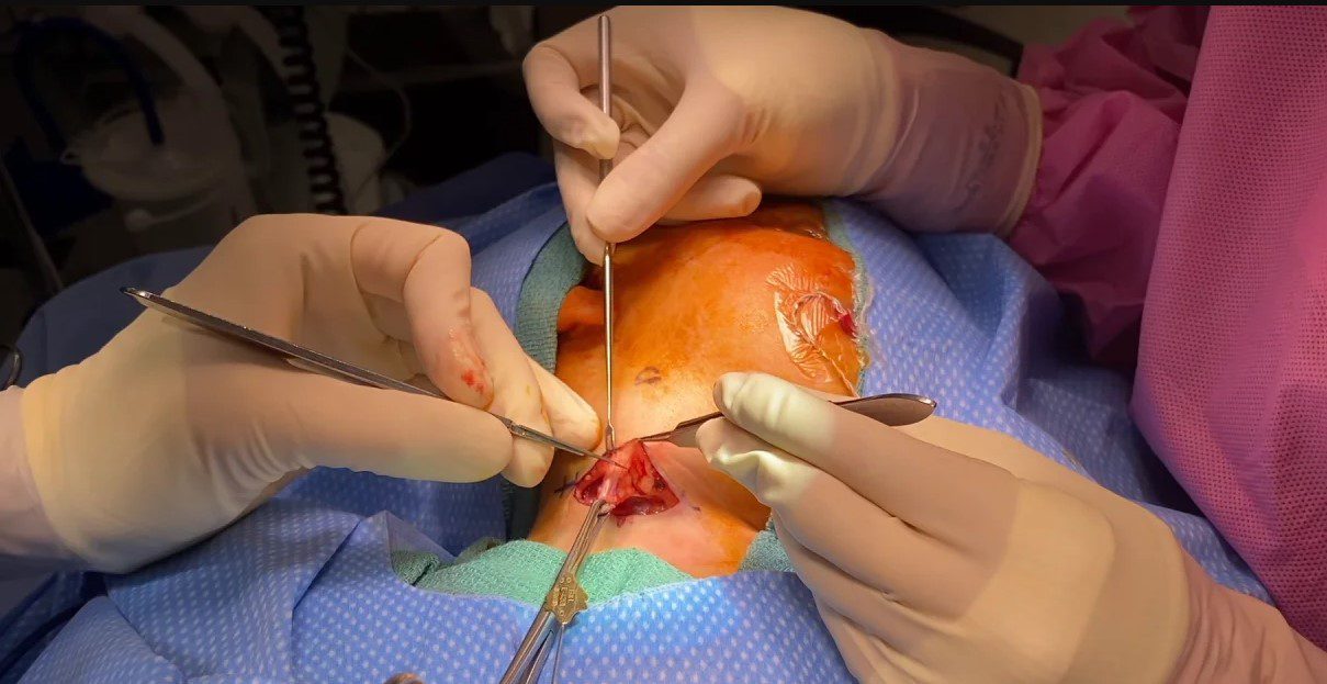 Step-Ladder Branchial Fistula Excision Package