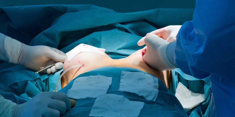Implant-Based Reconstruction Package