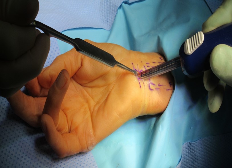 Endoscopic Carpal Tunnel Release Package