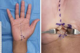 Open Carpal Tunnel Release Package