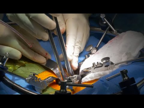 Artificial Cervical Disc Replacement Package