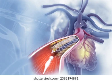 DJ Stent Placement Package