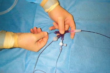 Catheter-Directed Thrombolysis Package