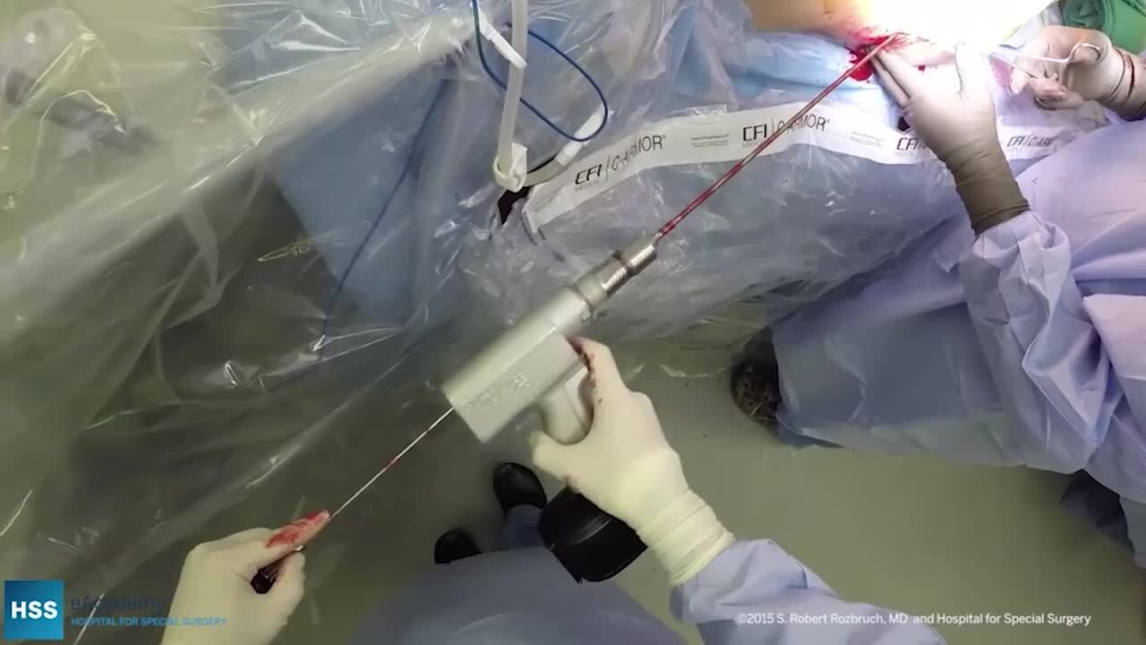 Internal Fixation Package (Cannulated Screws / DHS)