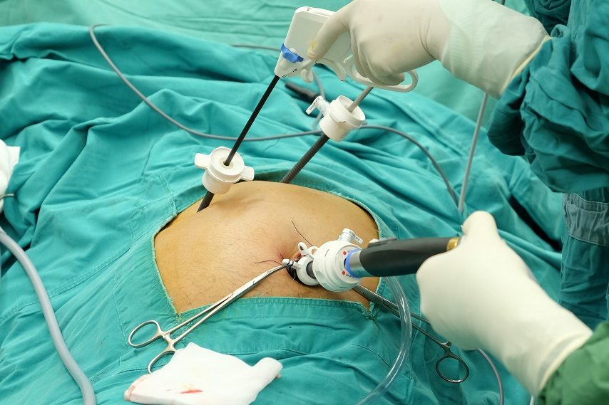 Laparoscopic Cholecystectomy Package