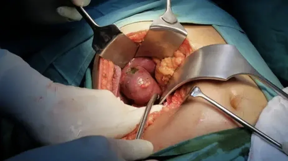 Open Cholecystectomy Package