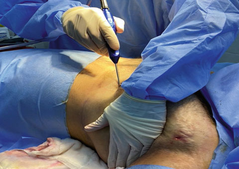Liposuction Only Package