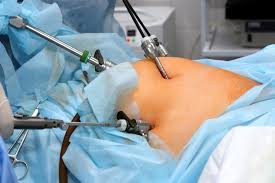 Laparoscopic Hernia Repair Package (TAPP / TEP)