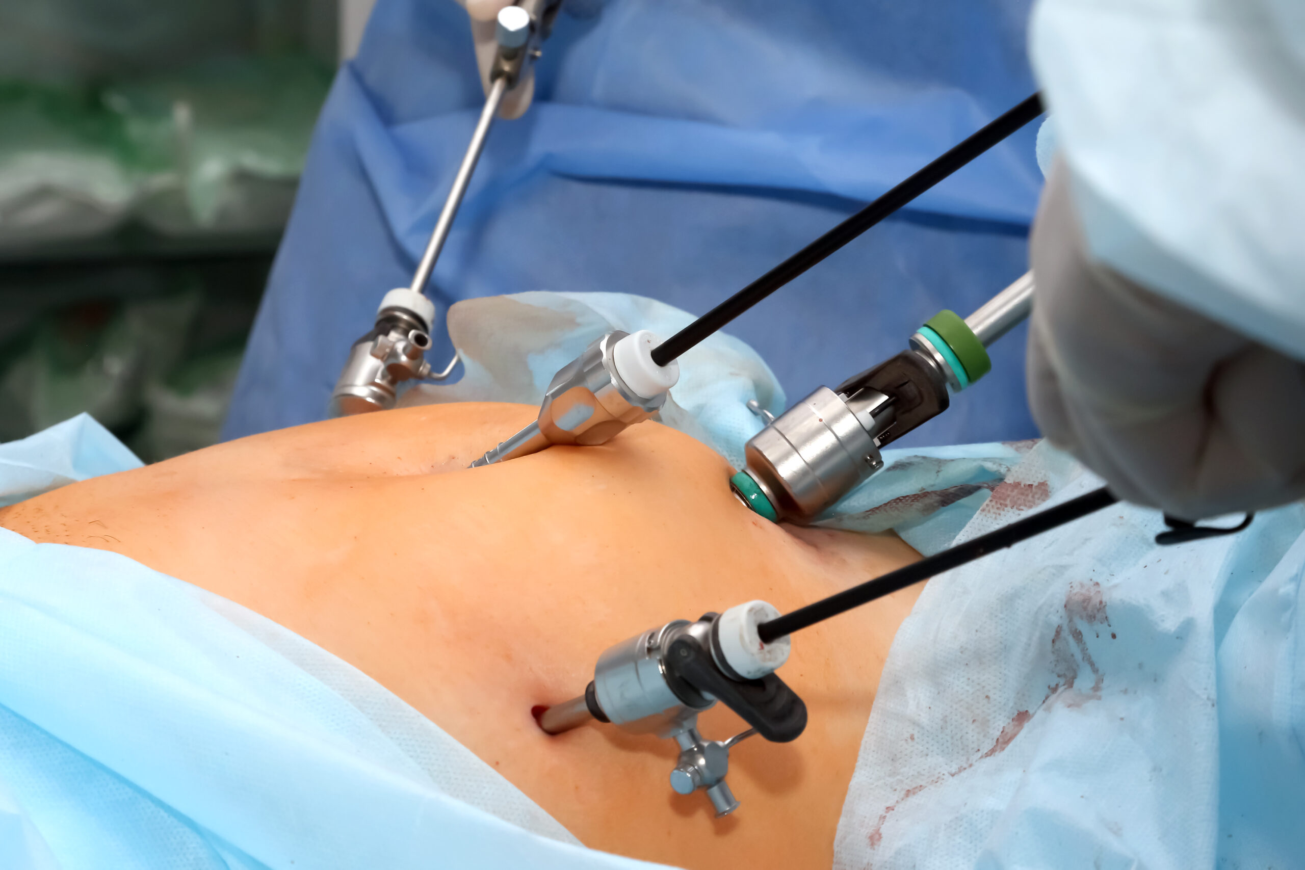 Laparoscopic Hysterectomy Package
