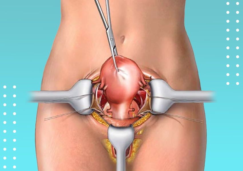 Open / Abdominal Hysterectomy Package