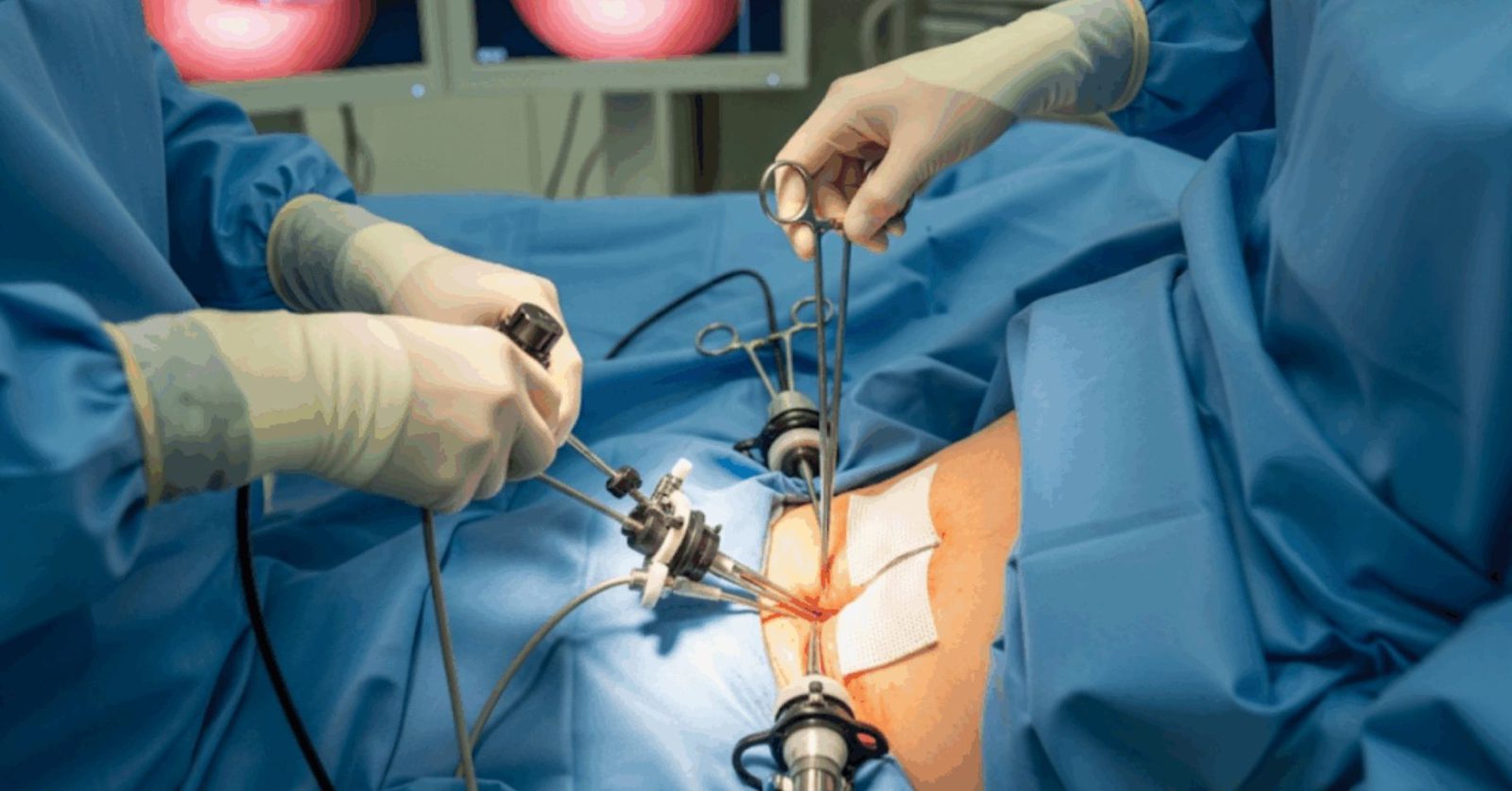 Laparoscopic Mesh Repair Package