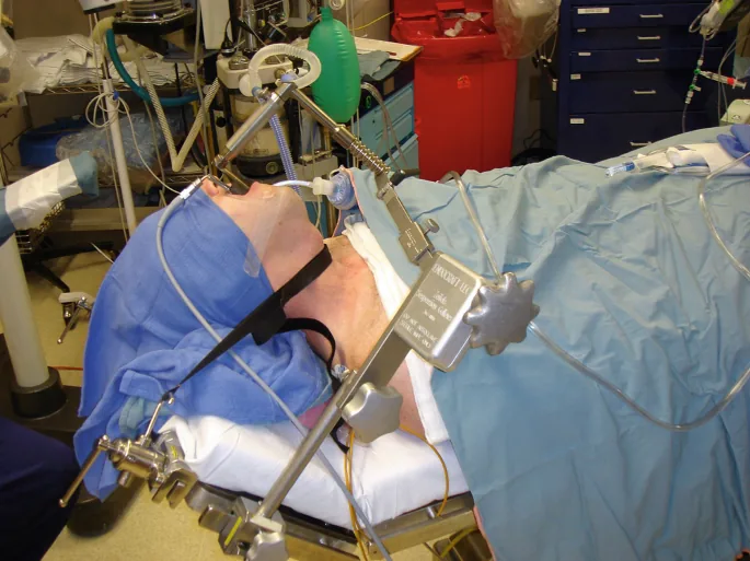 Laryngofissure with Standard Lesion Excision Package