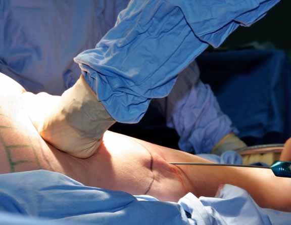 Liposuction-Assisted Removal Package