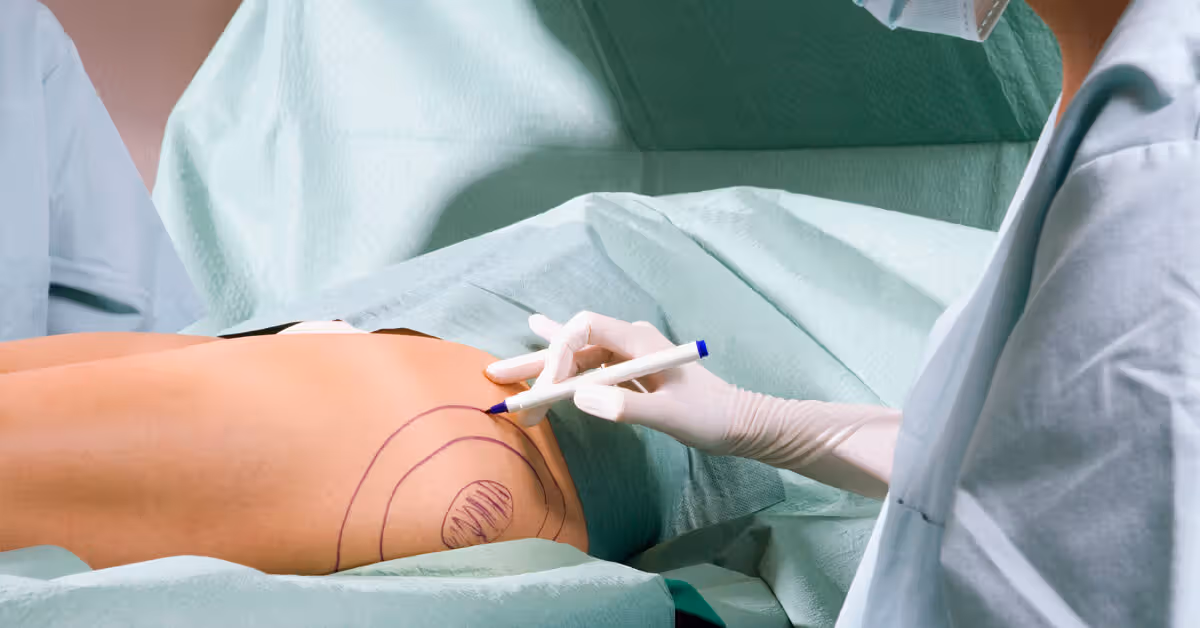 Traditional Tumescent Liposuction Package