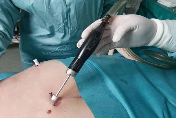 VASER Liposuction Package