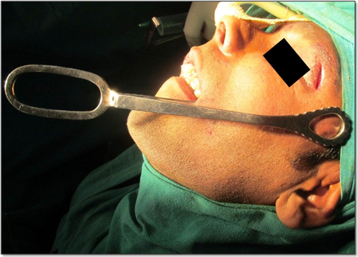 Closed Reduction Package (Gillies / Manual)