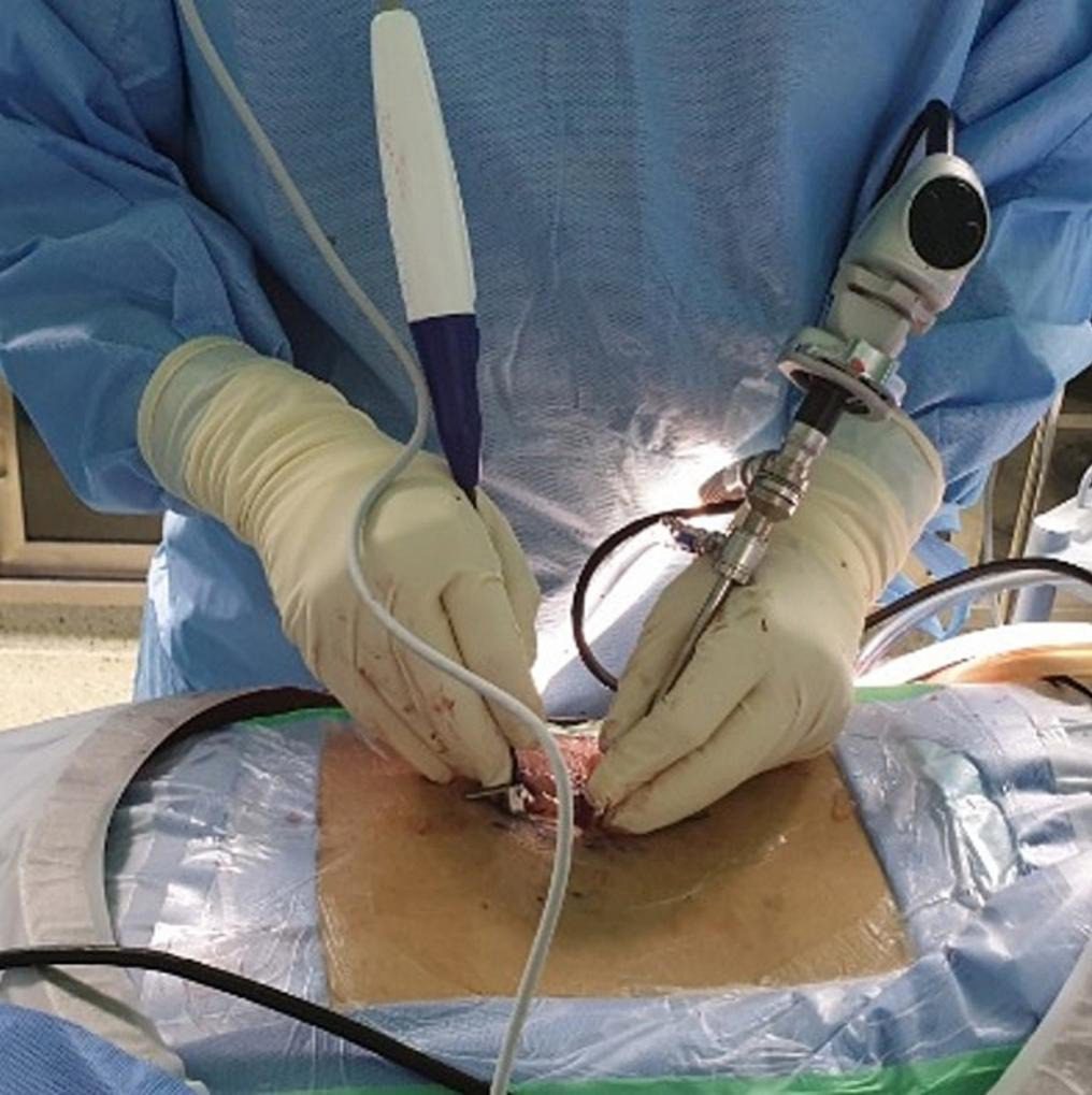 Endoscopic Discectomy Package
