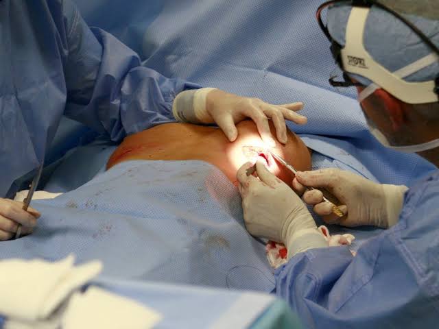 Volume Displacement Oncoplasty Package