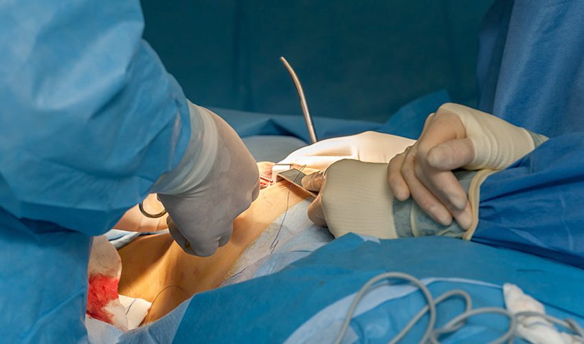 Volume Replacement Oncoplasty Package