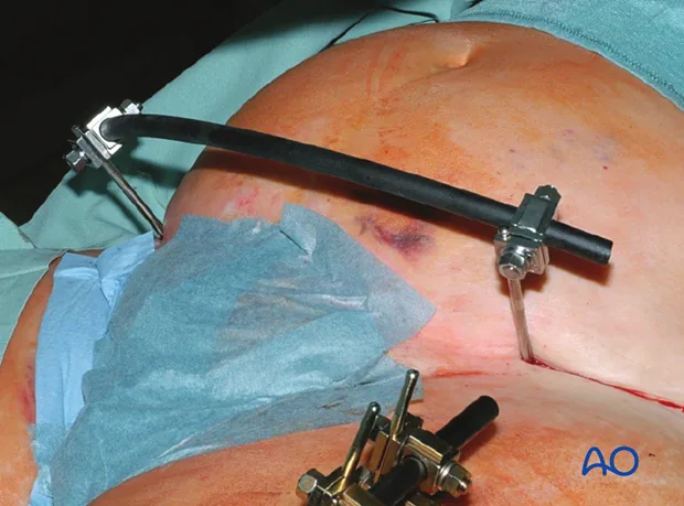 External Fixation Package (Standalone)