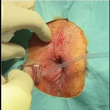 Incision & Drainage Package