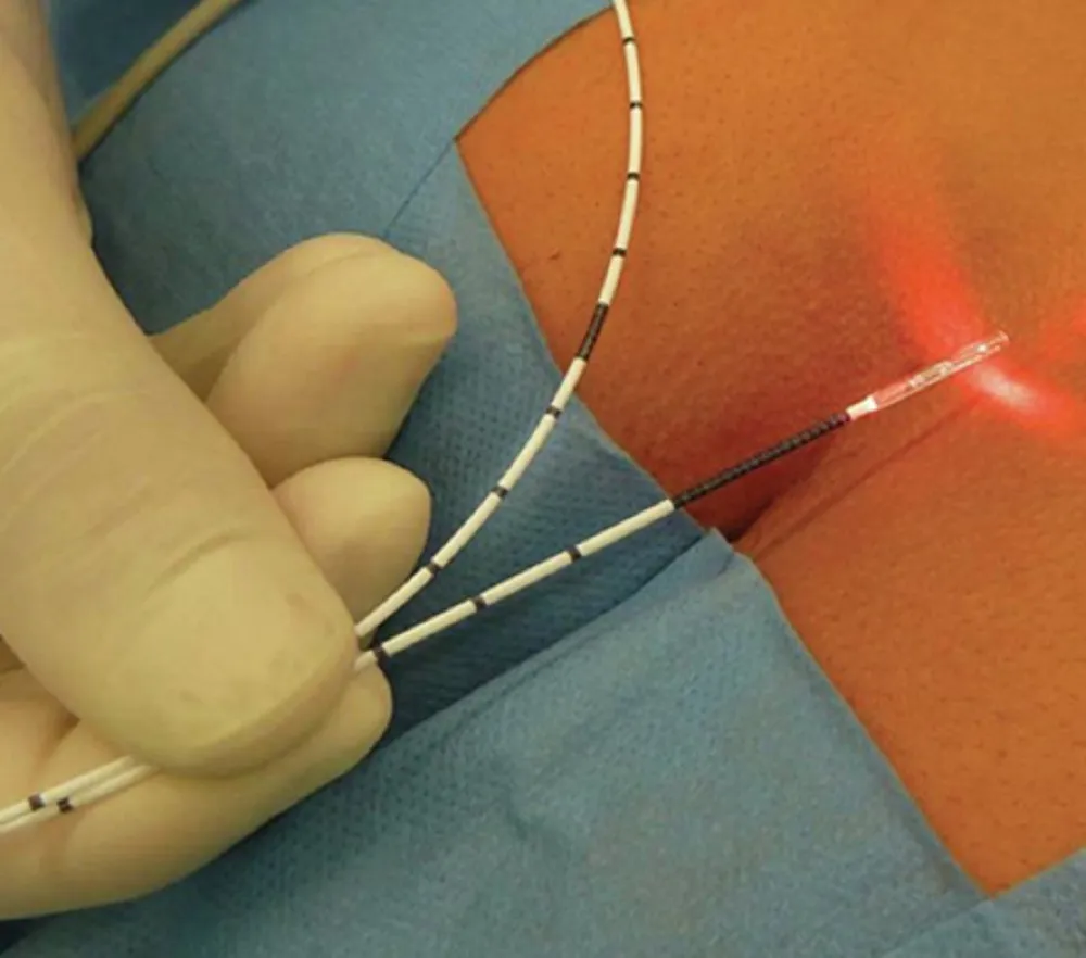 Laser Drainage Package