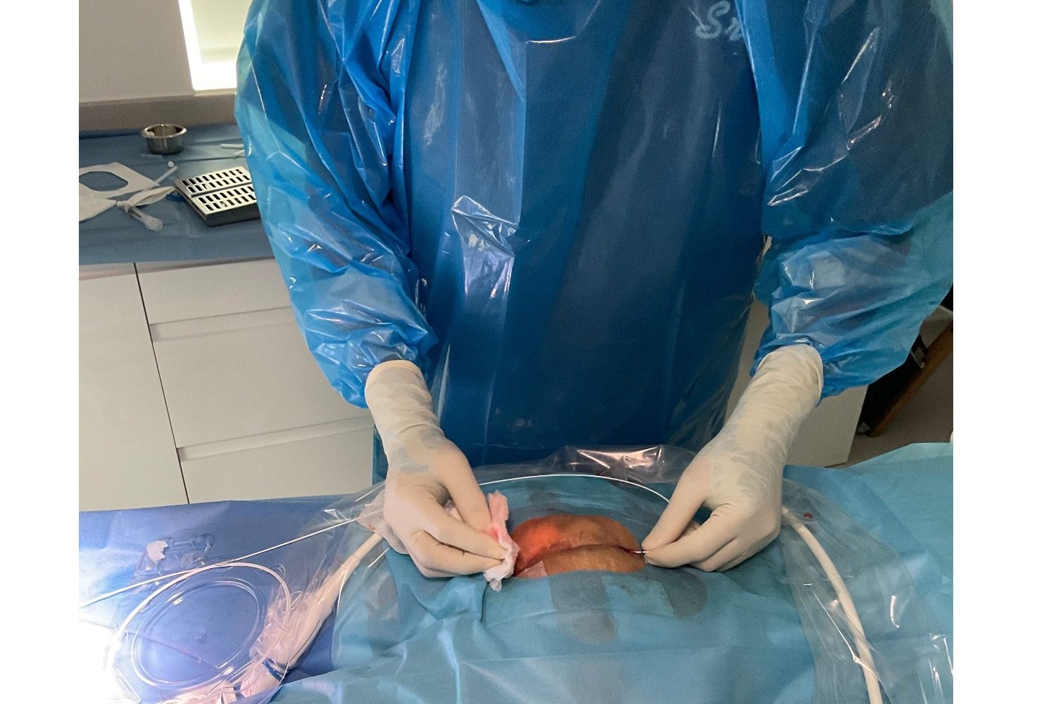 Open Excision & Flap Pilonidoplasty Package