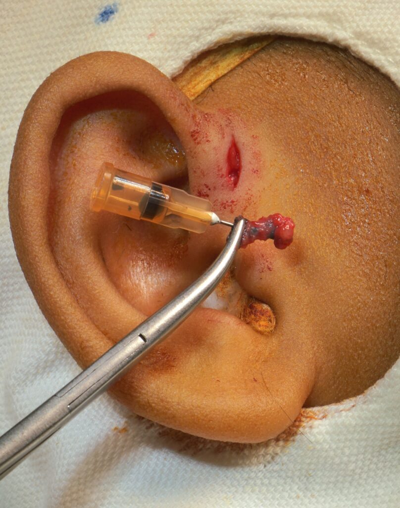 Standard Sinusectomy Package