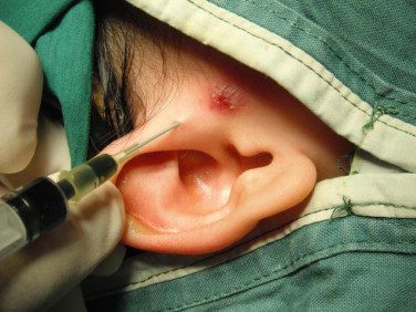 Supra-Auricular Approach Sinusectomy Package