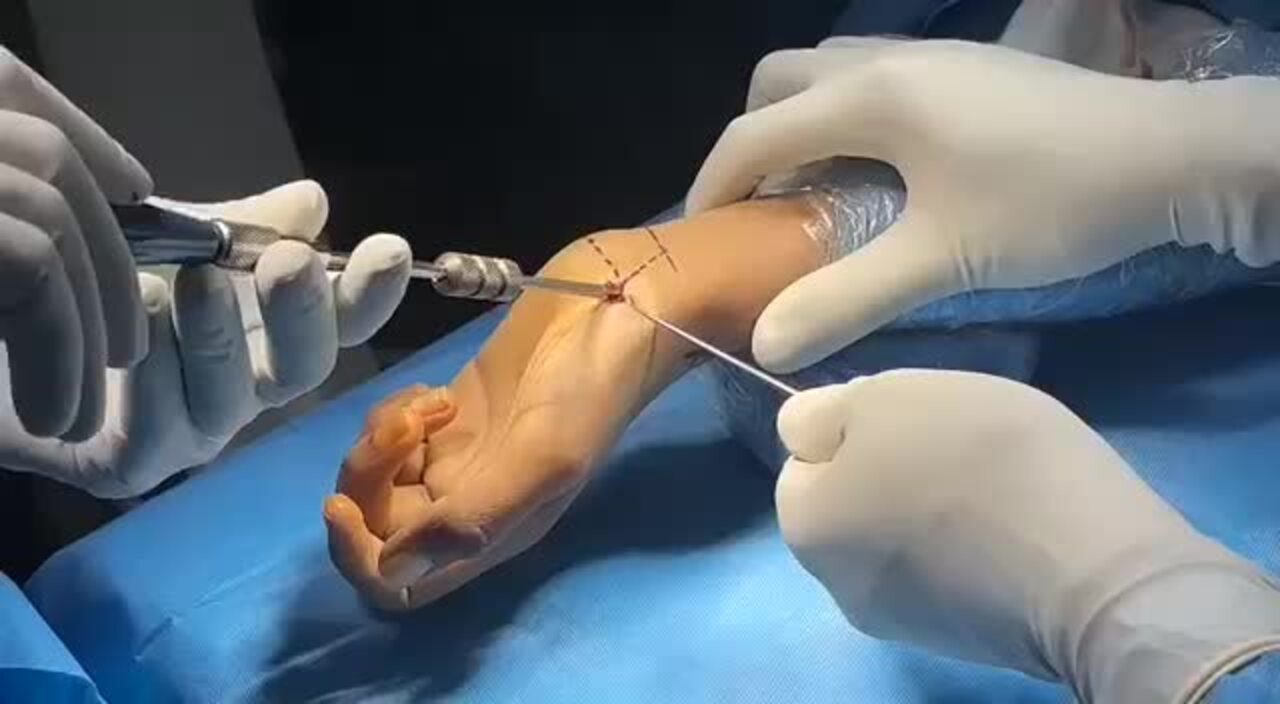 Percutaneous Screw Fixation Package (Herbert Screw)