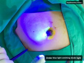 Dual Tracer SLNB Package (Blue Dye + Radioisotope)