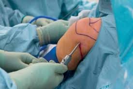 Arthroscopic Shoulder Surgery Package