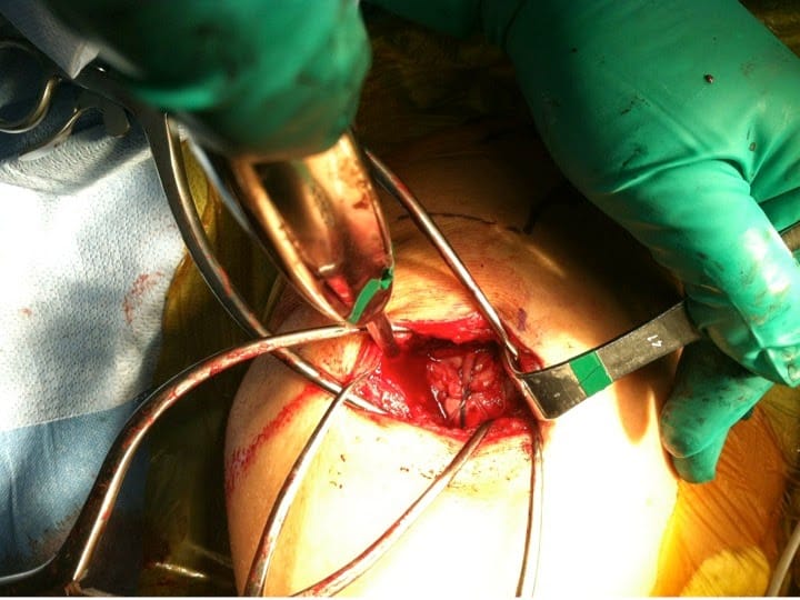 Open Shoulder Surgery Package