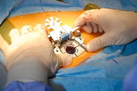Micro Lumbar Discectomy (MLD) Package