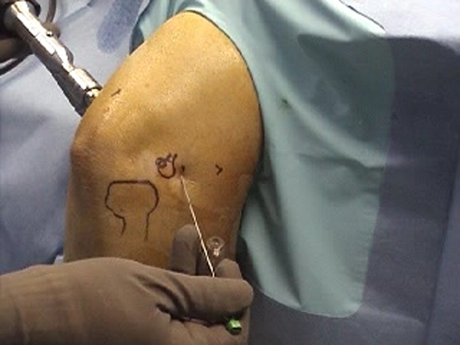 Arthroscopic Surgery Package