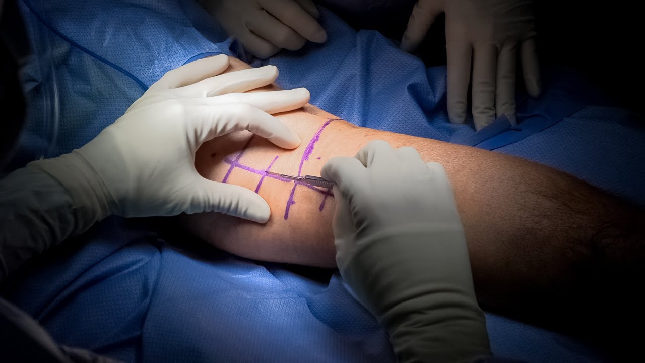 Single Plate ORIF Package (Lateral / Medial)