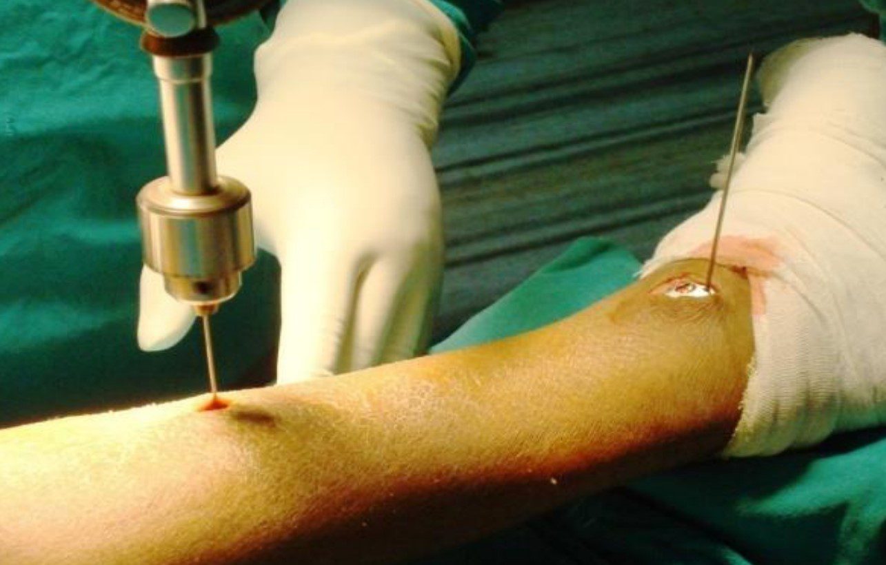 Minimally Invasive Plate Osteosynthesis (MIPO) Package