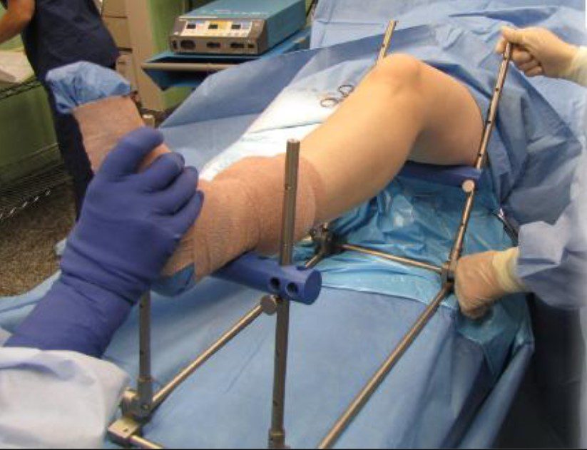 Open Reduction Internal Fixation (ORIF) Package