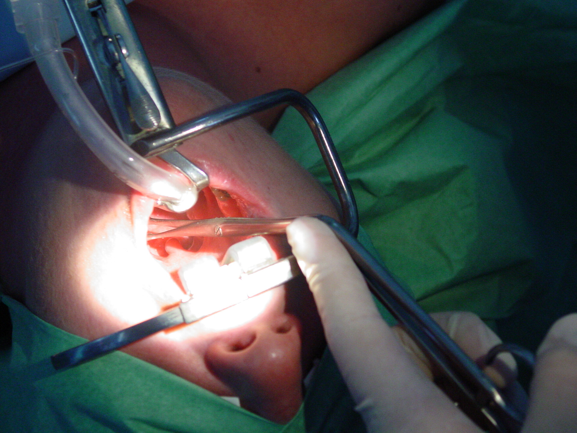 Traditional Tonsillectomy Package