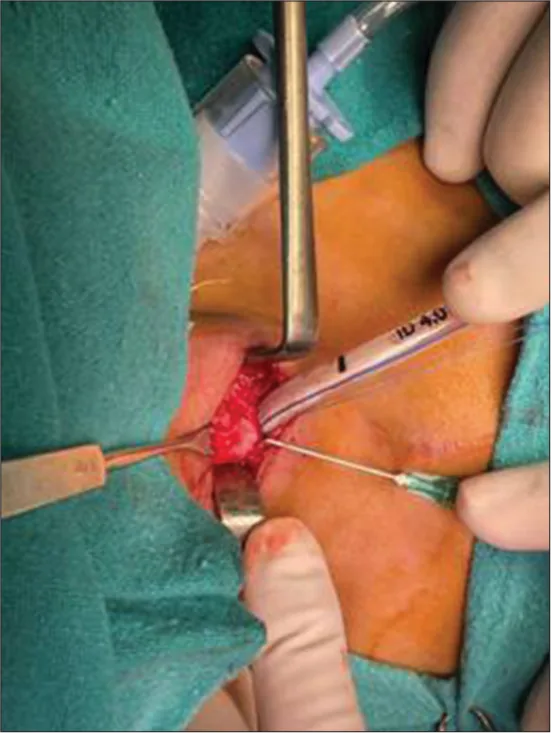 Extended Tracheal Resection with Release Manoeuvres Package
