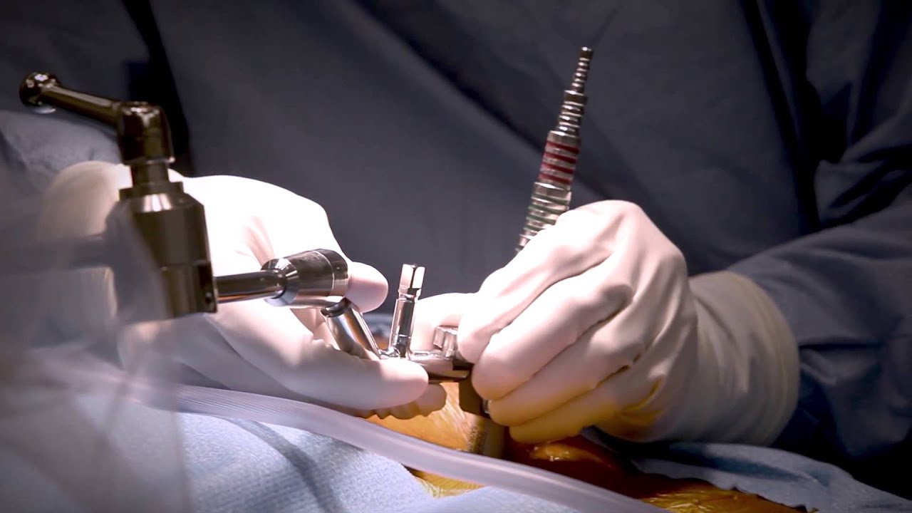 Three-Level MIS Decompression Package