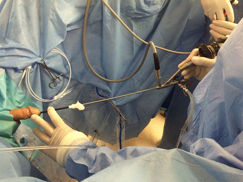 Semi-Rigid Ureteroscopy Package (URS)