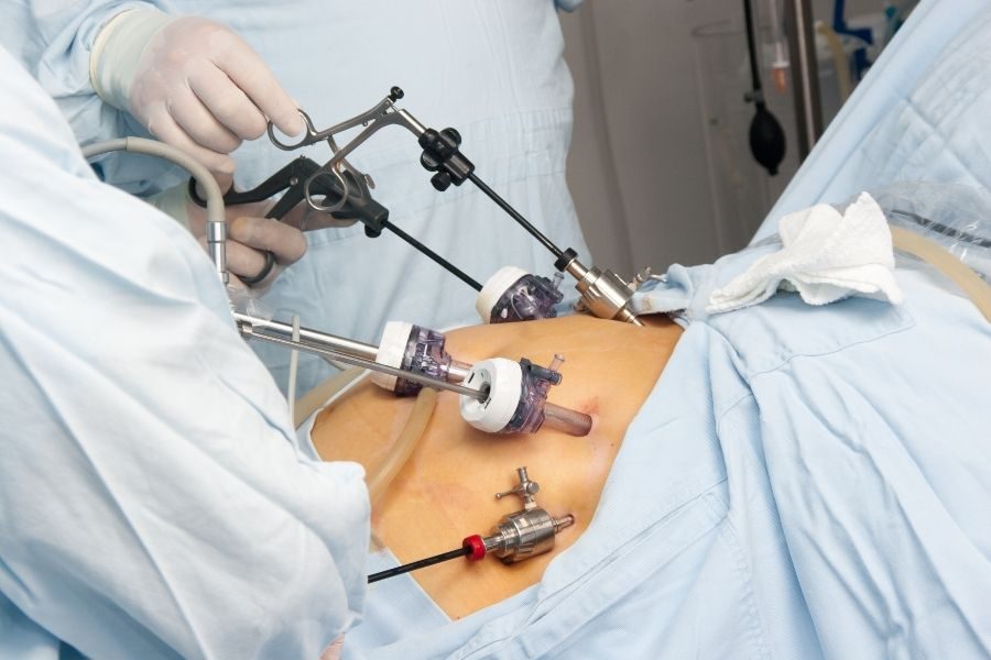 Laparoscopic Varicocelectomy Package