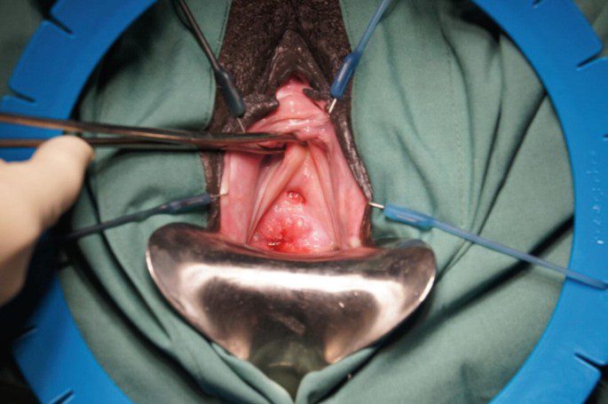 Abdominal (Transabdominal) VVF Repair Package